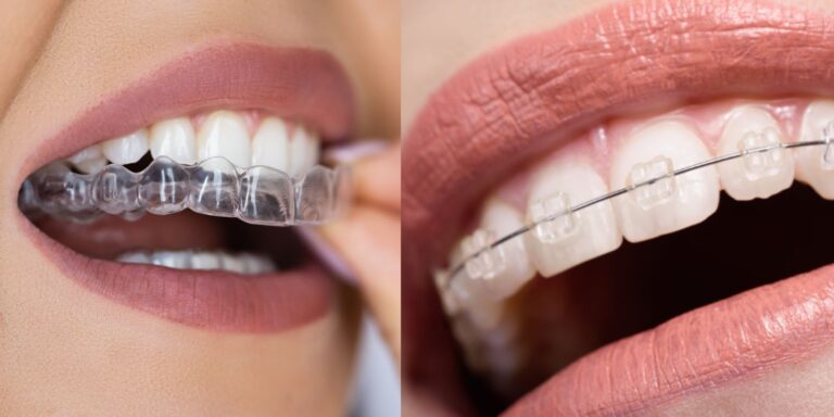 Ortodoncia fija con brackets de zafiro transparentes