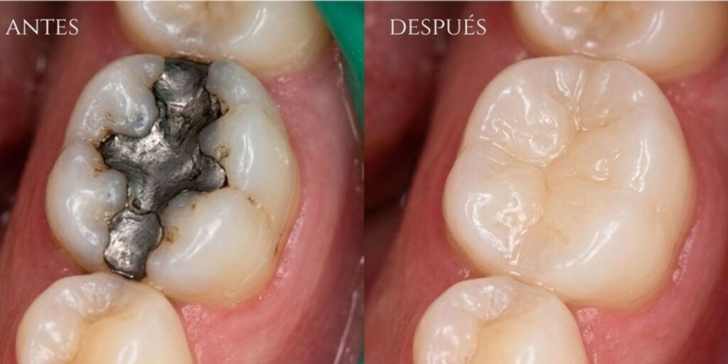 Reemplazo de amalgamas por resinas estéticas del color del diente