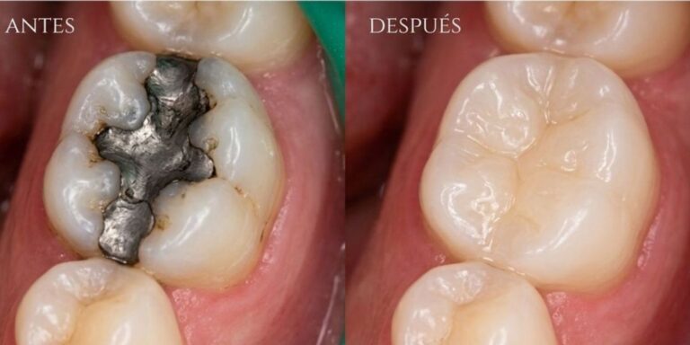 Reemplazo de amalgamas por resinas estéticas del color del diente