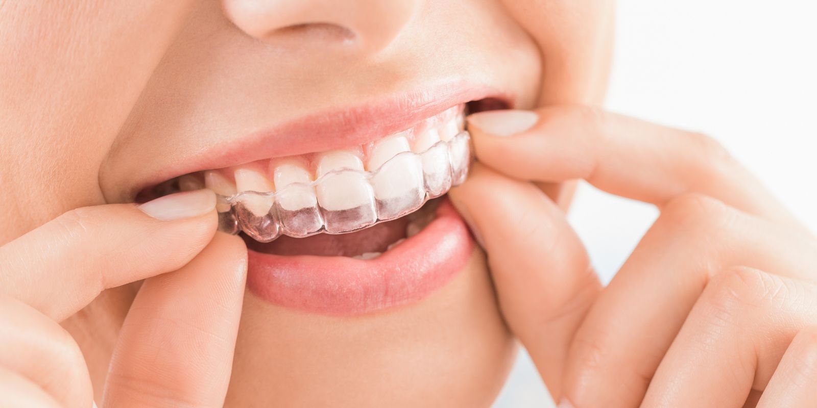 Ortodoncia invisible para adultos con alineadores transparentes