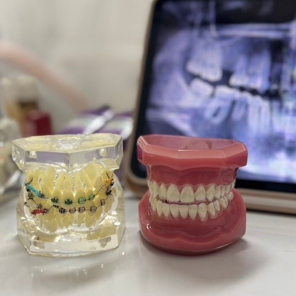 ortodoncia-brackets-alineadores-invisibles-dentarlet-Recoleta