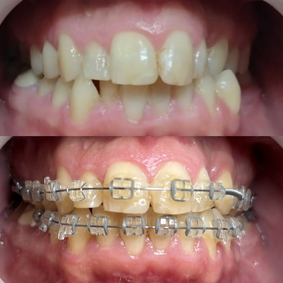 ortodoncia-brackets-esteticos-zafiro