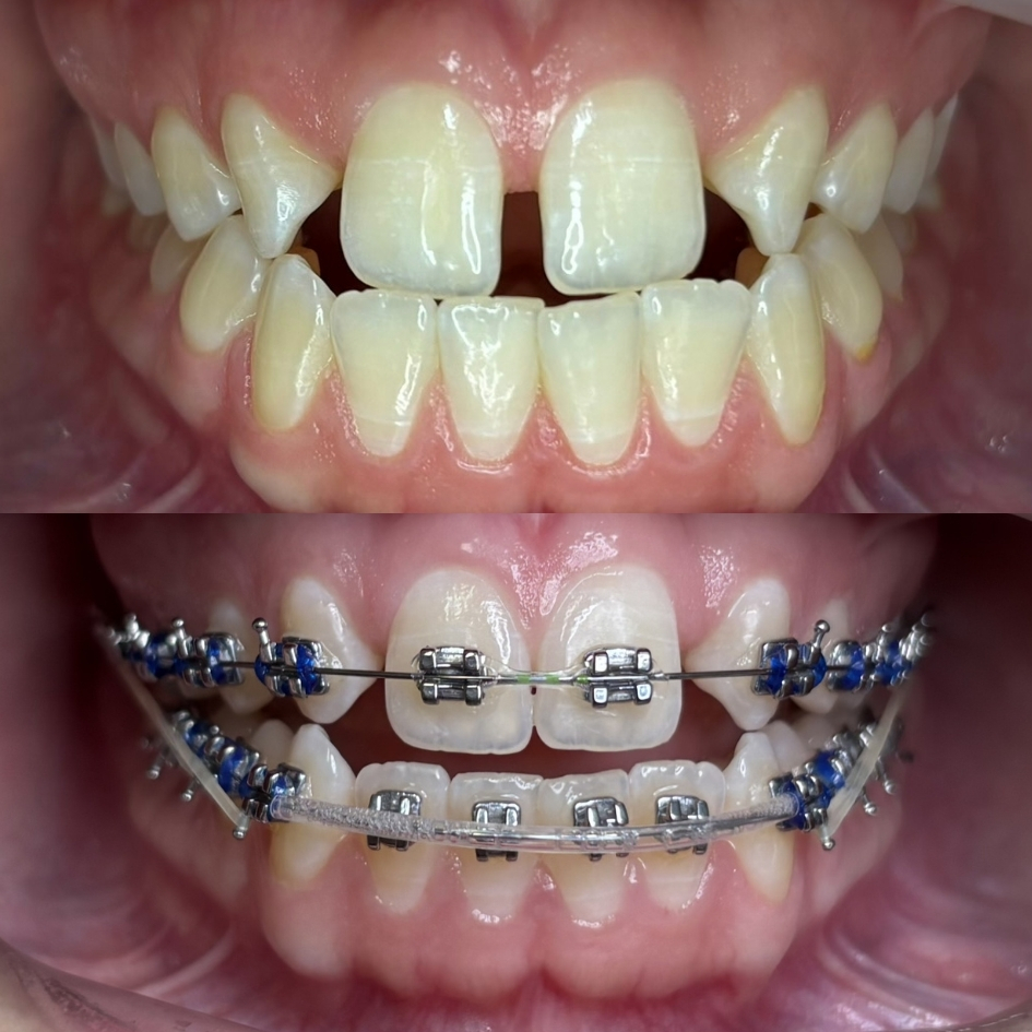 ortodoncia-brackets-metalicos-cierre-diastema