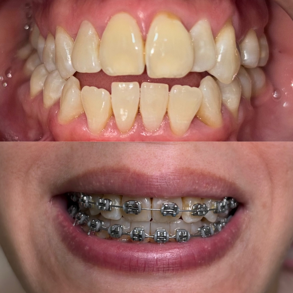 ortodoncia-brackets-metalicos-correccion-mordida
