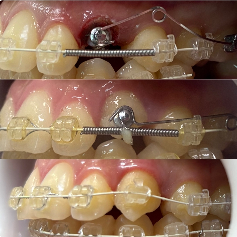 ortodoncia-brackets-zafiro-canino-retenido