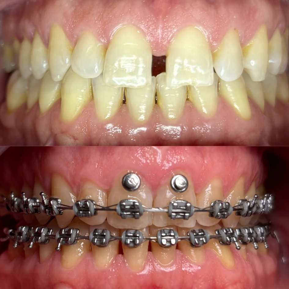 ortodoncia-cierre-diastema-brackets-metalicos