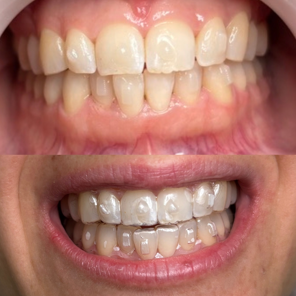 ortodoncia-invisible-alineadores-dentarlet-recoleta