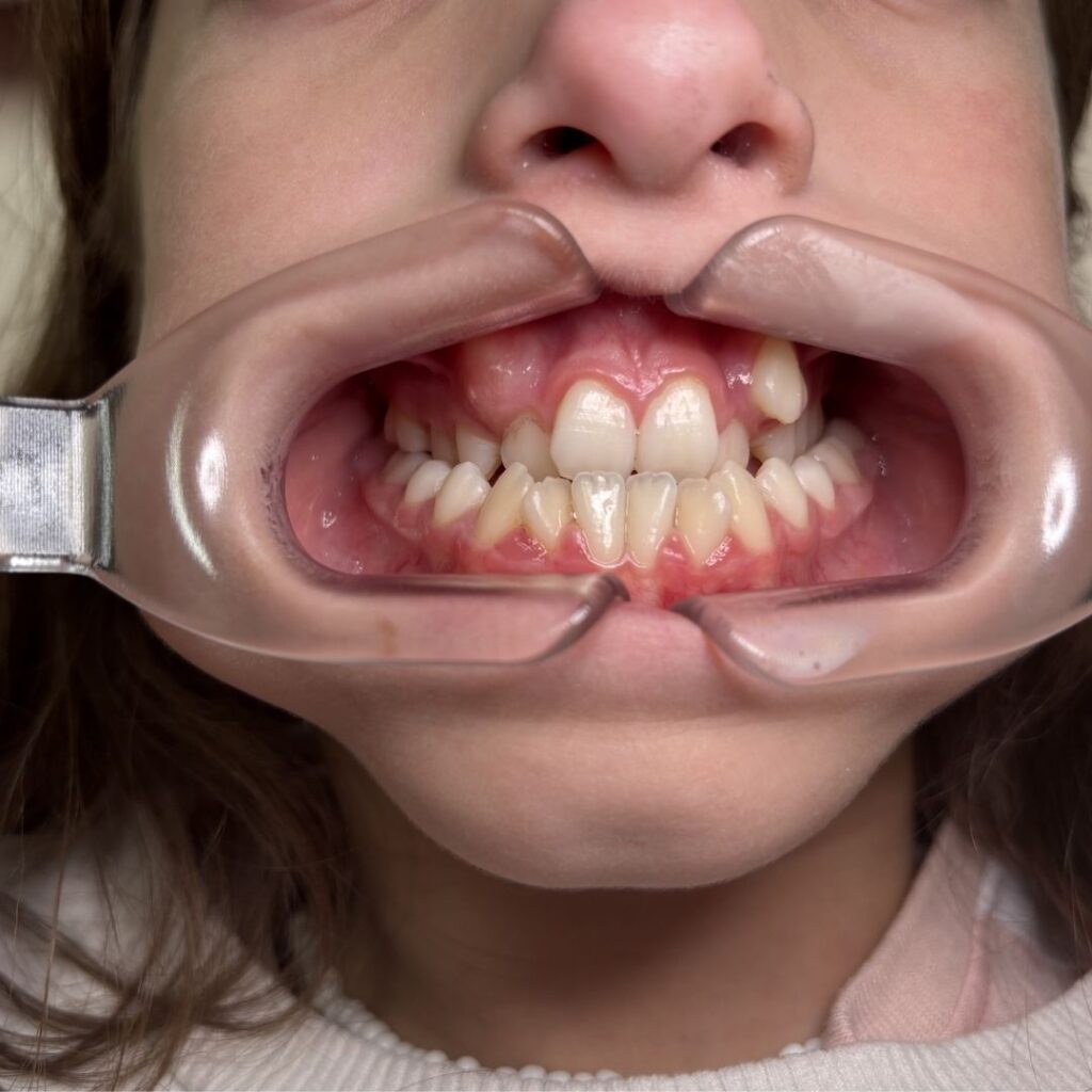 respirador bucal y dientes apiñados