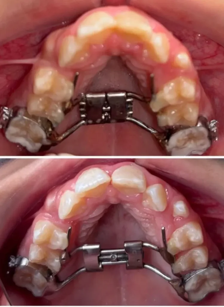 Evolución clínica de expansión maxilar con disyuntor palatino activado antes y después
