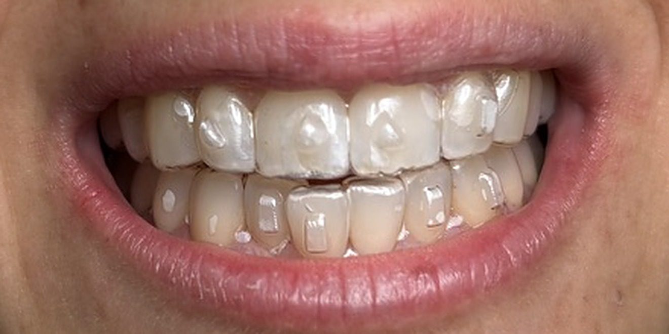 Ortodoncia invisible con alineadores transparentes en paciente real, Dentarlet Recoleta