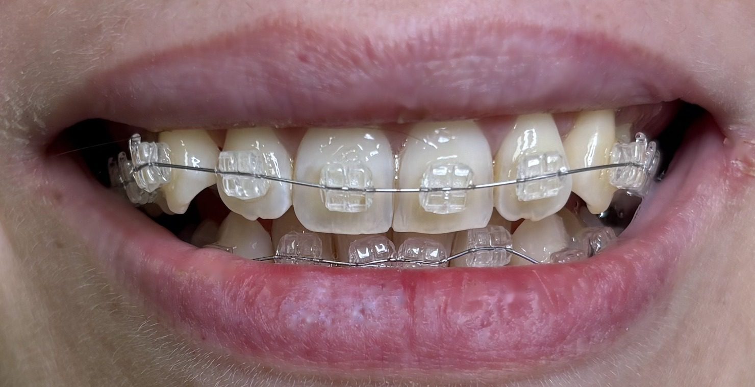 Brackets de zafiro en paciente real, ortodoncia discreta en Dentarlet Recoleta